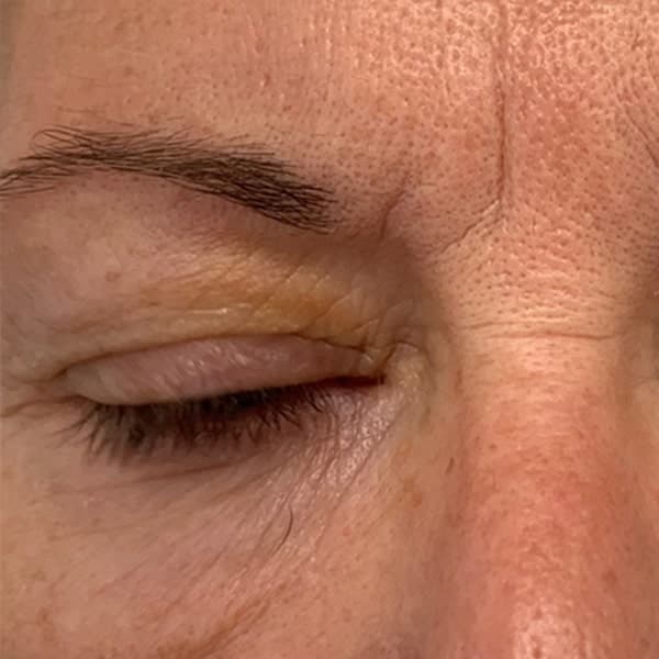 Região dos olhos — depois