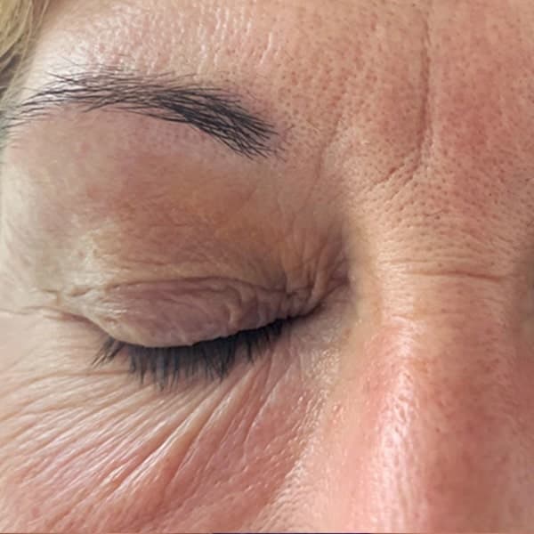 Região dos olhos — antes